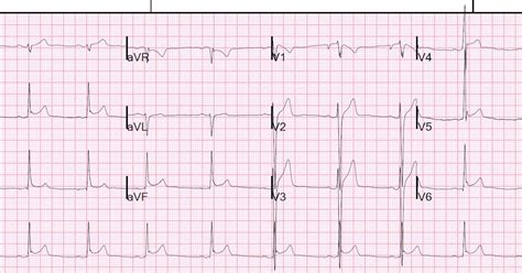 Dr Smiths Ecg Blog Inferior St Elevation What Is The Diagnosis