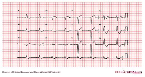 Left Bundle Branch Block Ekg Examples Wikidoc