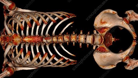 Bones Of The Torso 3d Ct Scan Stock Image C0522049 Science