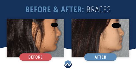Before After Braces See The Amazing Results Yourself Woodhill Dental Specialties