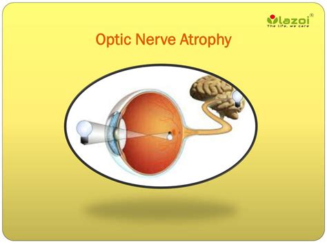 Ppt Optic Nerve Atrophy A Guide To Symptoms Causes And Treatment