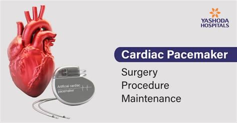 Pacemaker Surgery Procedure Risks Complications And Benefits