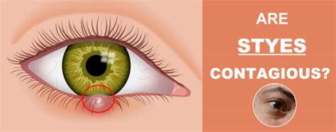 How To Treat A Stye Of A Childs Eye Causes Symptoms And Treatment