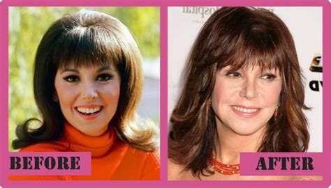 Marlo Thomas Plastic Surgery Did She Have It