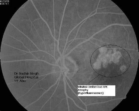 Fluorescein Angiography Is A Fundal Photography Performed In Rapid