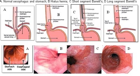 Barretts Oesophagus Dr Douglas Samuel