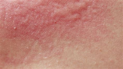 What Is Dermatitis Causes Treatments Advice For Irritated Skin Glamour UK
