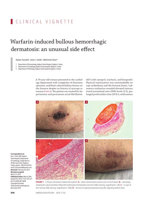 Pdf Warfarin‑induced Bullous Hemorrhagic Dermatosis An Unusual Side