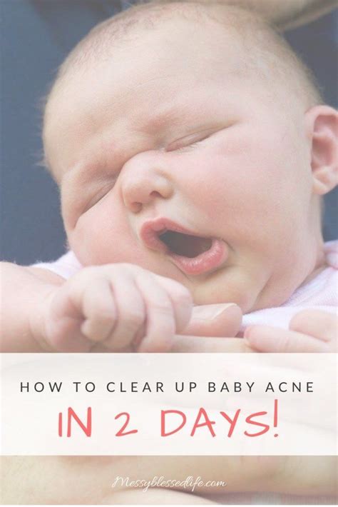 How I Cleared My Daughters Baby Acne Fast Baby Acne Baby Acne
