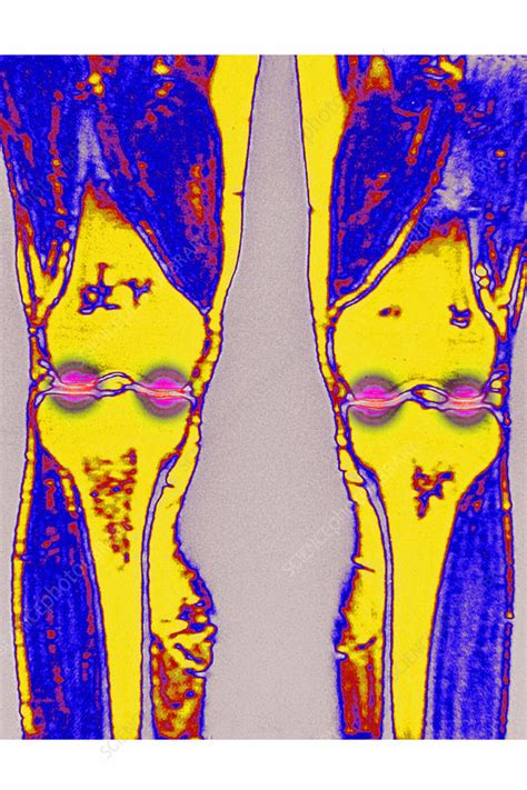Arthritis Mri Stock Image C0460185 Science Photo Library