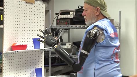 Amputee Able To Move Prosthetic Arms Simply By Thinking Abc11 Raleigh