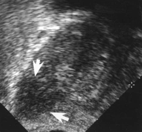 Endorectal Color Doppler Sonography And Endorectal Mr Imaging Features Of Nonpalpable Prostate
