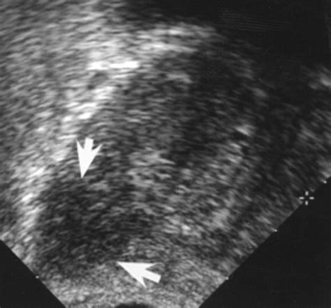 Endorectal Color Doppler Sonography And Endorectal MR Imaging Features Of Nonpalpable Prostate