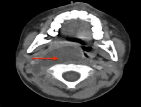 Ct Axial Image Showing The Well Defined And Rimenhancing Hypodense