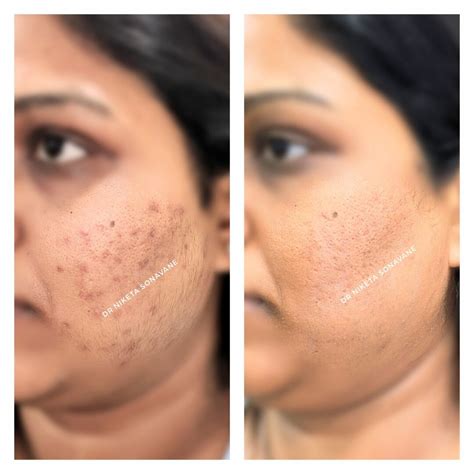 Pigmentation Treatment in Mumbai - Cost, Before and After ...
