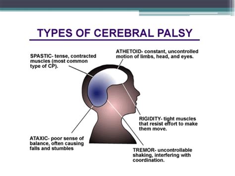 This affection is very frequent in the general population and manifests mostly with severe dysfunction involving several organs and districts. Cerebral palsy presentation