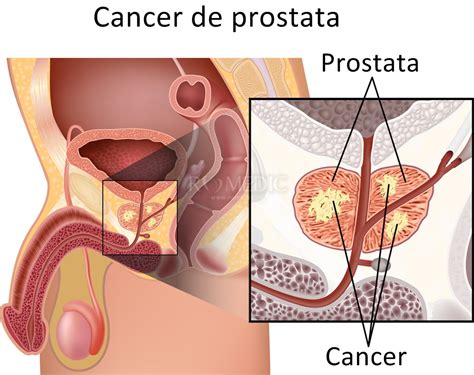 Cancerul de prostată important de știut