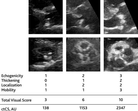 Examples On Visual Scoring In Patients With Various Aortic Valve