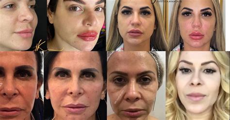 Fotos de famosos que fizeram harmonização facial antes e depois