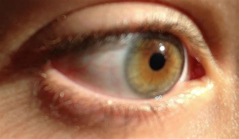 My Right Eye Is Split Vertically Brown On One Side And Green On The