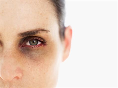 What Causes Dark Circles Around Your Eyes