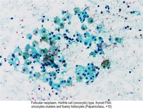 Pathology Outlines Hürthle Cell Neoplasm