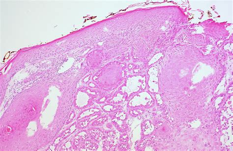 Acantholytic Squamous Cell Carcinoma Ed Uthman Flickr