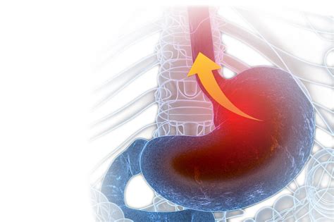 Gerdacid Refluxhiatus Hernia The Role Of Surgery