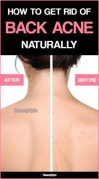 How To Get Rid Of Back Acne Fast Naturally Star Beauty Back Acne