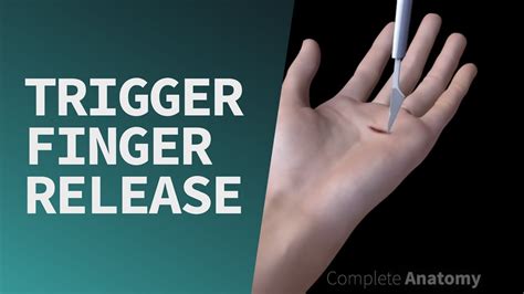 Trigger Finger Carolina Regional Orthopedics