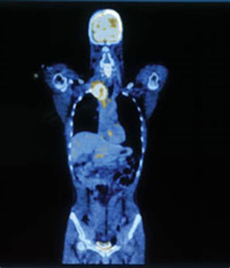 Benign brain tumors usually have clearly defined borders and usually aren't deeply rooted in brain tissue. Synthesis, a UC Davis Cancer Center Publication ...