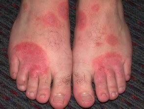 Peds Rash On Bottom Of Feet