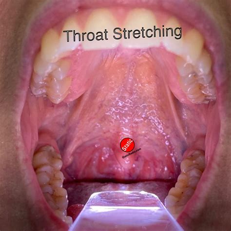 Throat Stretching Static Radio