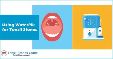 Waterpik For Tonsil Stones Removal Guide 2022