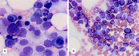 A Core Bone Marrow Biopsy Showing Prominence Of Plasma Cells