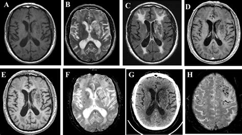 Brain Mri And Ct In A 86 Year Old Man With Mild Cognitive Download