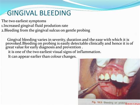 Ppt Stages And Clinical Features Of Gingivitis Powerpoint