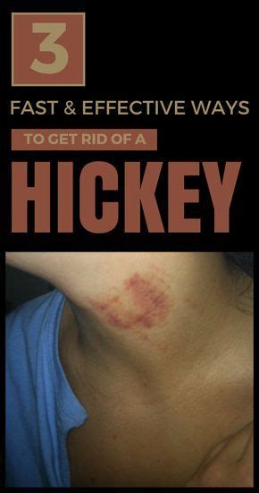 3 Fast And Effective Ways To Get Rid Of A Hickey Get Rid Of Hickies
