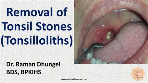 Tonsil Stone Removal Tonsillolith Removal By Dr Raman Dhungel Youtube