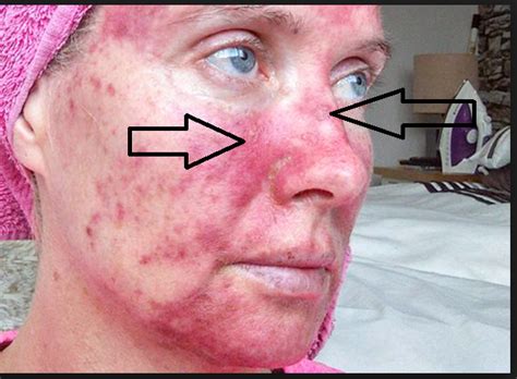 Actinic Keratosis Skin Guide To Ak Causes Symptoms Risk Treatment