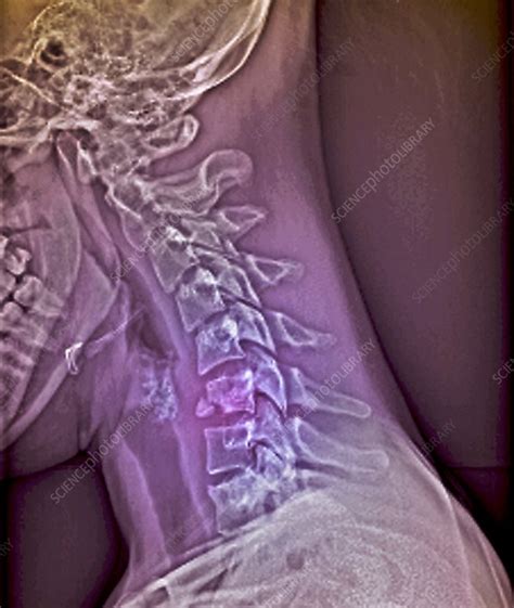 Fractured Neck X Ray Stock Image M3301730 Science Photo Library