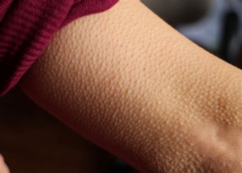 Goosebumps And Other Bodily Reactions Explained Stacker