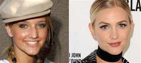 Ashlee Simpson Plastic Surgery With Before And After Photos