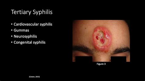 Syphilis Disease Presentation Youtube