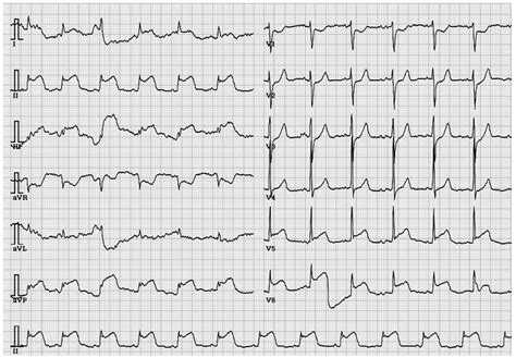 Subarachnoid Hemorrhage Misdiagnosed As An Acute St Elevation