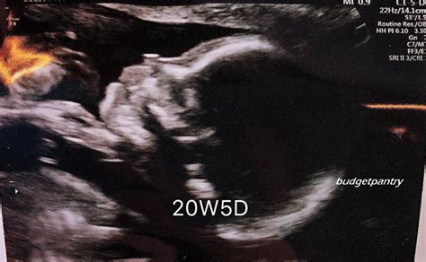 Pregnancy 2 The Second Trimester Cdds 20th Week Fetal Anomaly Scan