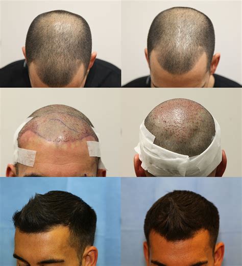 Hair Transplant Months Post Surgery Results Before And After Hair