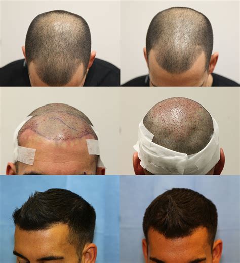 Hair Transplant 3 Months Post Surgery Results Before And After Hair