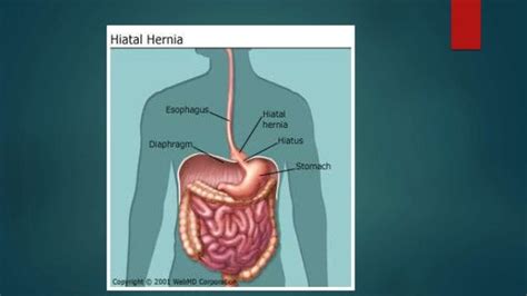 Hiatal Hernia