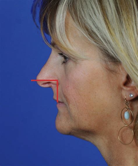 Droopy Nasal Tip Correction Dr Hilinski